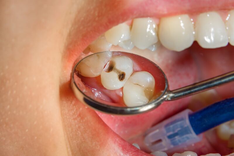 Las caries generan dolor de muela.